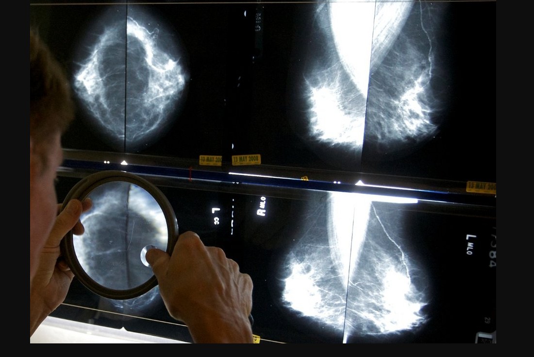 ΚΑΡΚΙΝΟΣ ΤΟΥ ΜΑΣΤΟΥ: ΤΙ ΔΕΙΧΝΟΥΝ ΤΑ ΣΤΟΙΧΕΙΑ ΣΤΗΝ ΕΛΛΑΔΑ